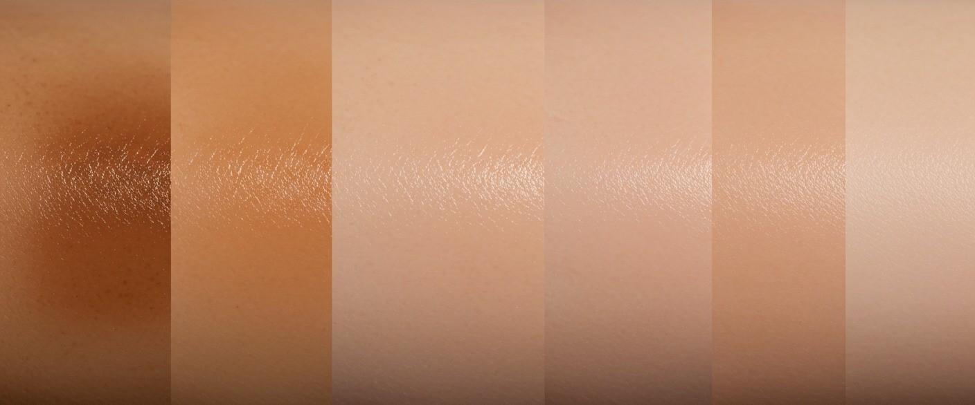 How to Fade Post-Inflammatory Hyperpigmentation: Tips and Treatments