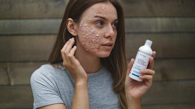 How to Remove Acne Scabs Overnight: Fast and Safe Tips How to Remove Acne Scabs Overnight: Fast and Safe Tips